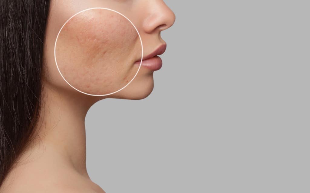 photo-before-and-after-treatment-for-acne-a-young-girl-with-a-problem-picture-id1209195011